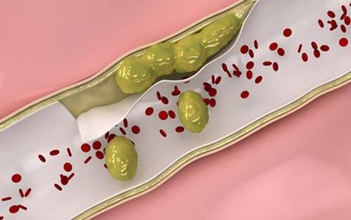 http://www.dkn.tv/wp-content/uploads/2017/10/1-clean-arteries-1475034329441-0-0-322-438-crop-1475034363669.jpg